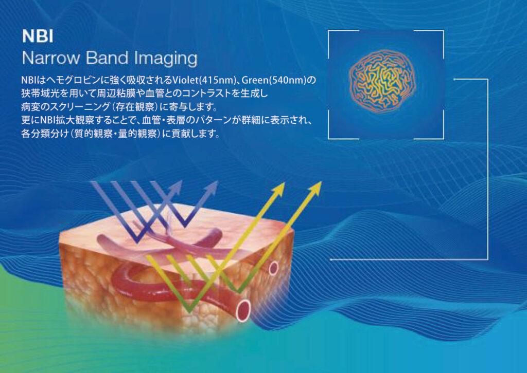 NBI（狭帯域光観察：Narrow Band Imaging）
