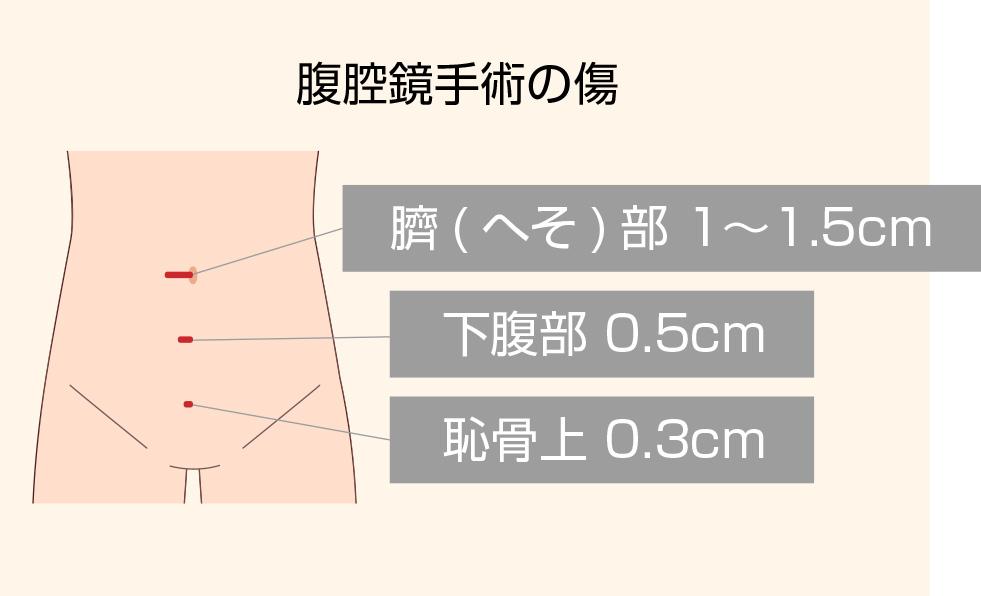 腹腔鏡手術の傷