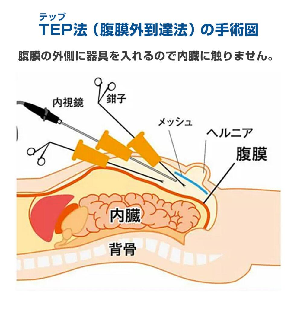 TEP法