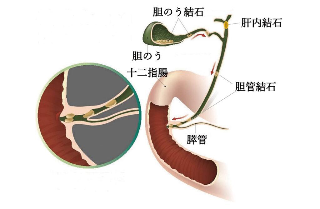 胆石