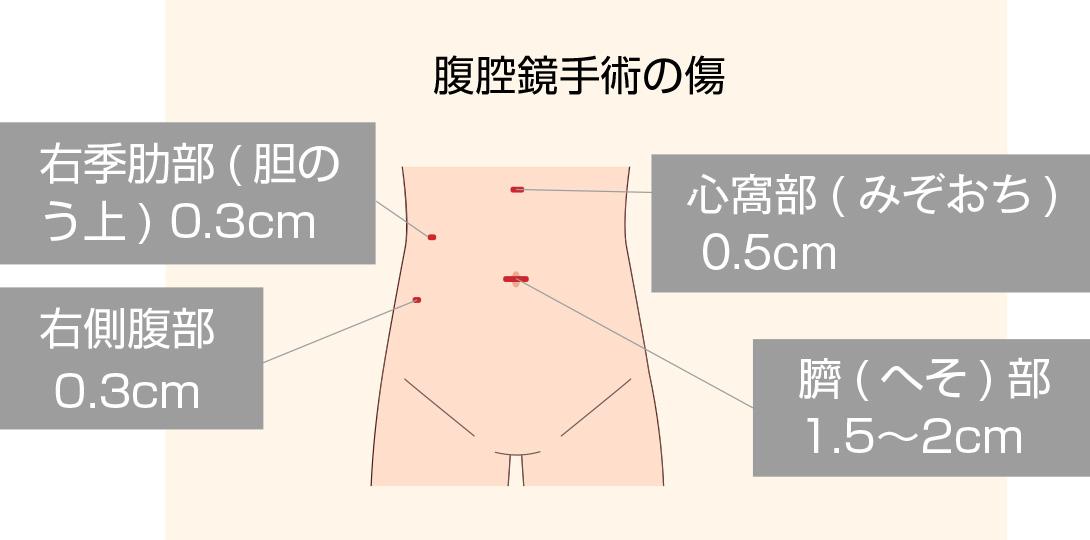 腹腔鏡手術の傷