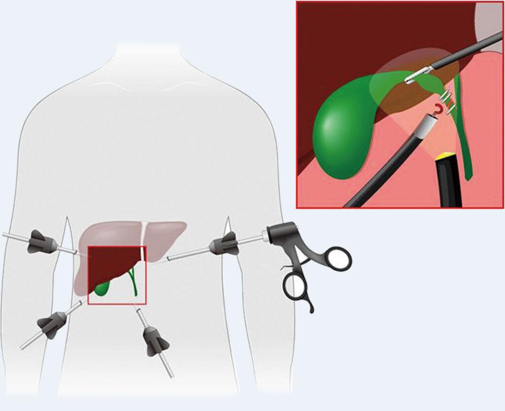 腹腔鏡下胆嚢摘出術