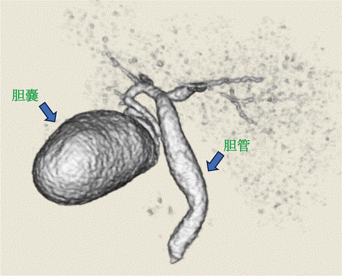 DIC-CT（点滴静注胆道造影CT）