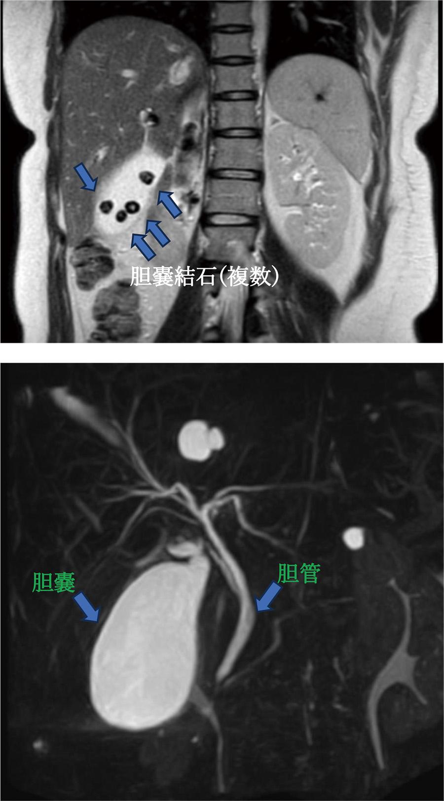 MRCP（磁気共鳴胆管膵管造影）