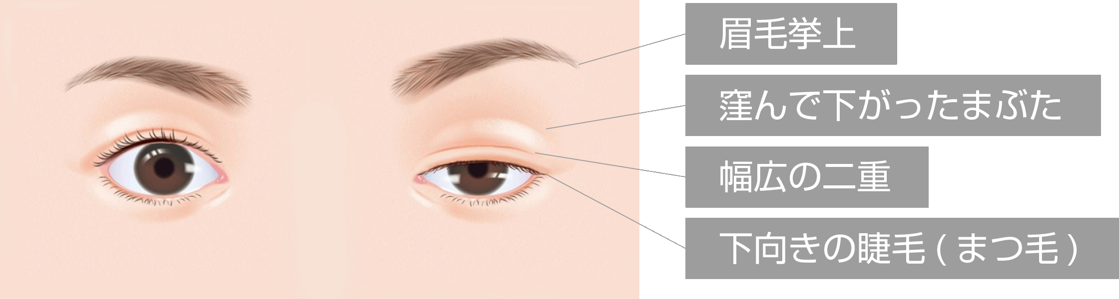 眼瞼下垂の症状