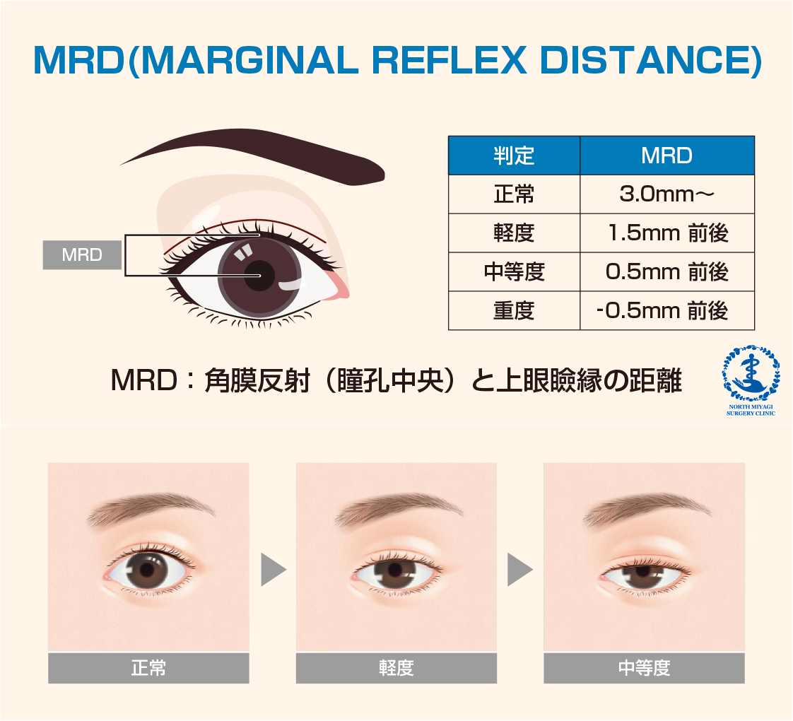 眼瞼下垂の重症度
