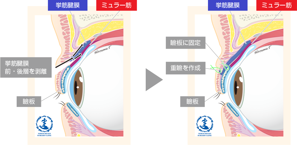 挙筋腱膜前転術