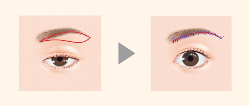 眉毛下皮膚切除