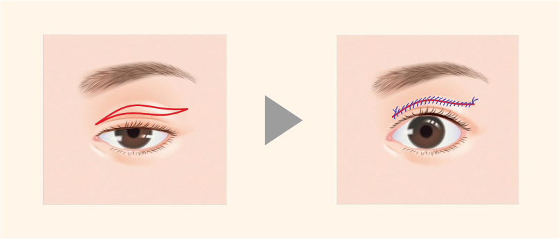 重瞼部皮膚切除