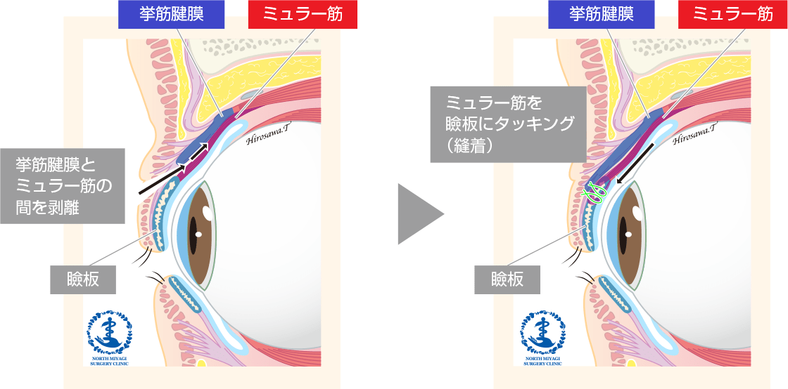ミュラー筋タッキング（Muller Tuck法）